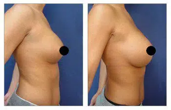 A woman's breast before and after a revision surgery to go bigger.