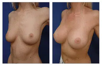 A woman's breast before and after Breast Augmentation surgery in Beverly Hills.