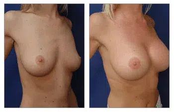 A woman's breast undergoes a dramatic transformation before and after undergoing Breast Augmentation in Beverly Hills.