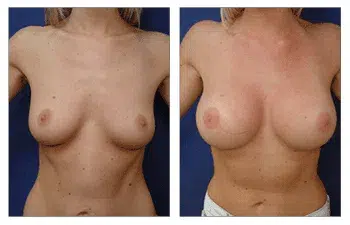 A woman's breasts before and after undergoing breast augmentation in Beverly Hills.