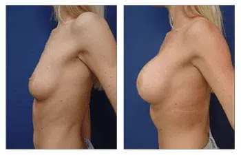 A woman's breast before and after undergoing Breast Augmentation in Beverly Hills.