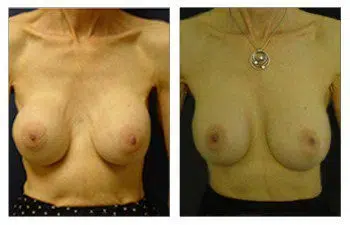 A woman's breasts before and after breast augmentation surgery.