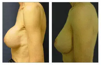 A woman's breast before and after severe revision surgery.