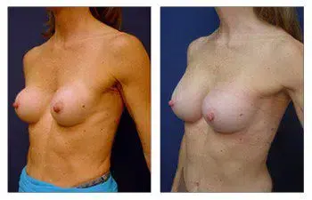 A woman's breast, exhibiting capsular contracture and/or asymmetry, is observed before and after surgery.