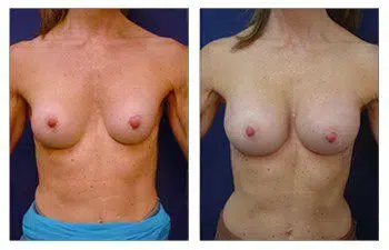 A woman's breast before and after surgery, showcasing the effects of Capsular Contracture and Asymmetry.