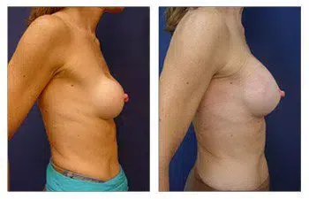 A woman's breast before and after surgery, showcasing the effects of capsular contracture or asymmetry.