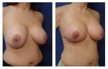 A woman's breasts before and after breast surgery performed by a Breast Augmentation Revision Surgeon in Newport Beach.