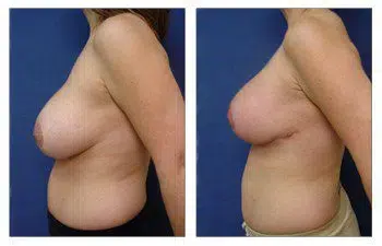 The transformation of a woman's breast before and after a breast augmentation surgery performed by a skilled surgeon specializing in revision procedures in Newport Beach.