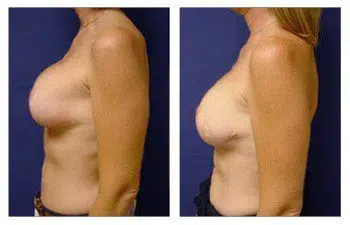 Before and after breast augmentation surgery performed by a skilled surgeon specializing in revision procedures.