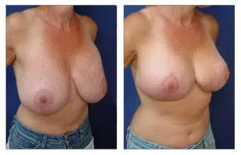 A woman's breasts before and after breast lift surgery.