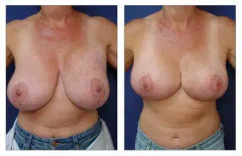 A woman's breasts before and after breast revision surgery.