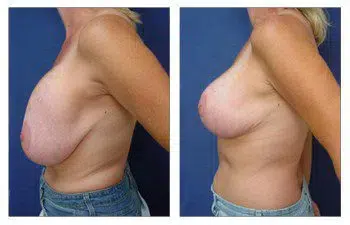 A woman's breast before and after Breast Lift surgery.