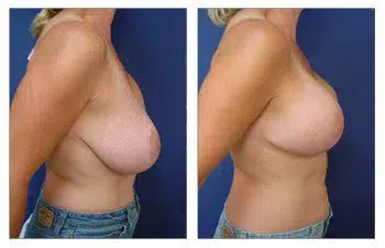 A woman's breast before and after a Breast Lift surgery.