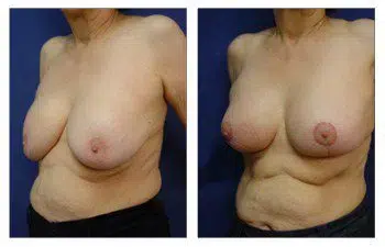 Breast Augmentation: A woman's breasts before and after surgery.