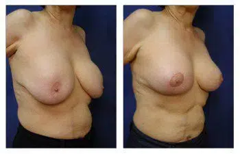 A woman's breast before and after Breast Augmentation surgery.