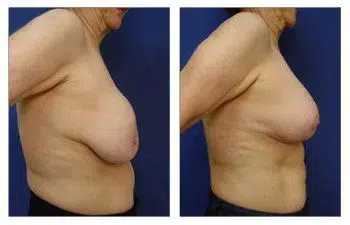 A woman's breast before and after Breast Augmentation surgery.