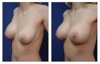 A woman's breasts undergoing a breast augmentation for revision of deflated implant.