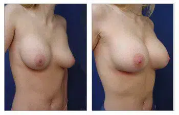 A woman's breast before and after Breast Augmentation surgery.