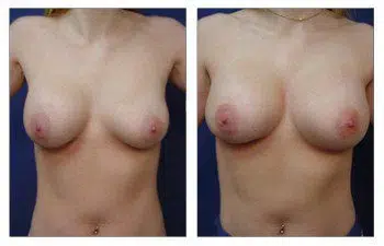 A woman's breasts before and after breast augmentation revision.