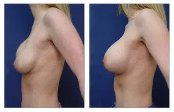 A woman's breast before and after Breast Augmentation surgery.