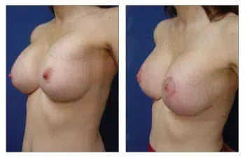 A woman's breast before and after breast augmentation surgery.