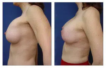 A woman's breast before and after breast augmentation surgery.