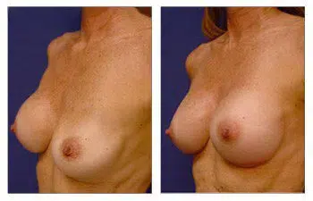 Correction of implant deflation to enhance breast augmentation before and after.