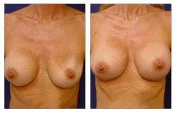 Before and after breast augmentation showcasing the correction of implant deflation.