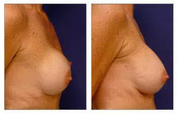 A woman's breast before and after correction of implant deflation.