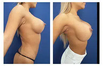 A woman's breasts before and after Enblok Capsulectomy surgery.