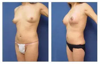 Before and after tummy tuck with breast lift to increase breast mound size.