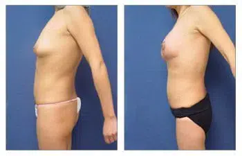 Tummy tuck and breast lift with implant augmentation before and after.