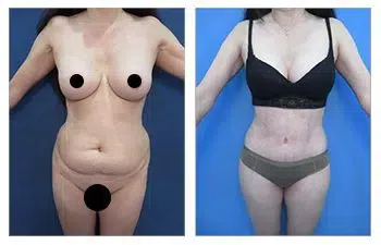 Check out the amazing tummy tuck transformation with these before and after photos shared on social media.