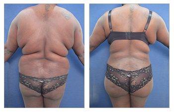 35-year-old female patient who had a Brazilian Buttock Lift – Rear view