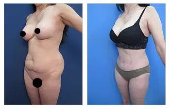 Check out these amazing before and after photos of a tummy tuck procedure. Share them on social media to see the incredible transformation!