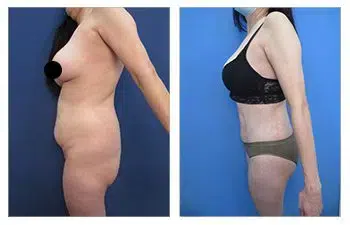 Before and after photos of a tummy tuck can be found on social media.