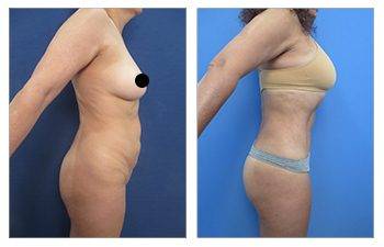 View the results of a tummy tuck before and after undergoing advanced liposuction revision.