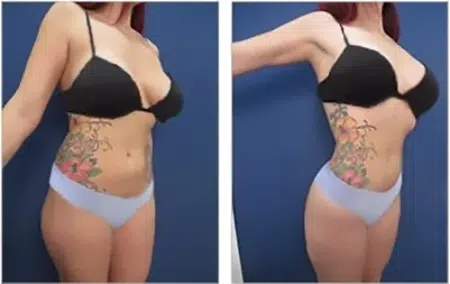 Before and after pictures of a woman with tattoos in West Hollywood.