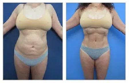 Before and after images of a tummy tuck in West Hollywood.