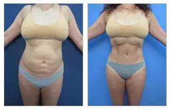 Check out the transformation of a woman's body before and after undergoing liposuction in West Hollywood.