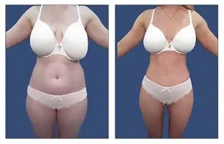 Before and after liposuction West Hollywood.