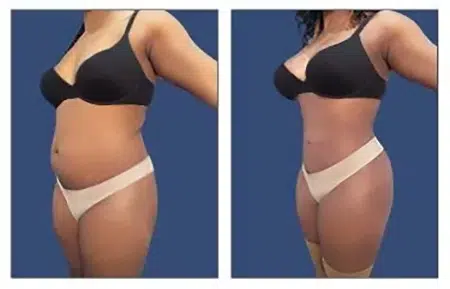 Before and after photos of a tummy tuck in West Hollywood.