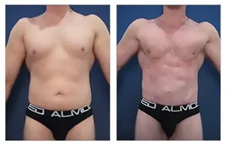 Before and after photos of a tummy tuck with liposuction in West Hollywood.