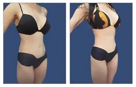 A woman in a bikini before and after liposuction in West Hollywood.