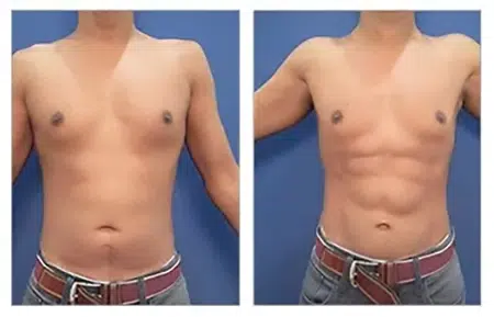 Before and after photos of a tummy tuck in West Hollywood.