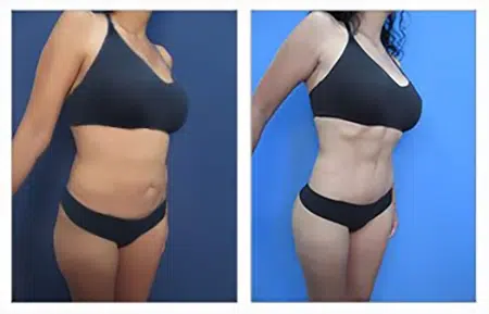 A woman in a bikini before and after undergoing liposuction in West Hollywood.