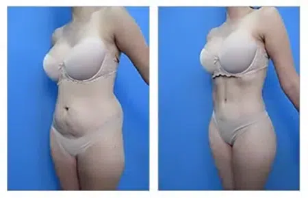 View the stunning before and after results of a tummy tuck in West Hollywood.