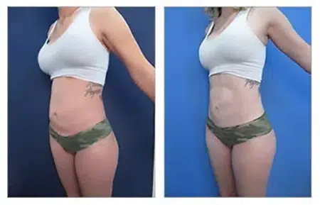 Before and after photos of tummy tuck with liposuction in West Hollywood.