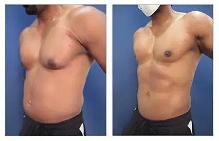 View tummy tuck before and after pictures at our West Hollywood clinic to see the transformation with liposuction.