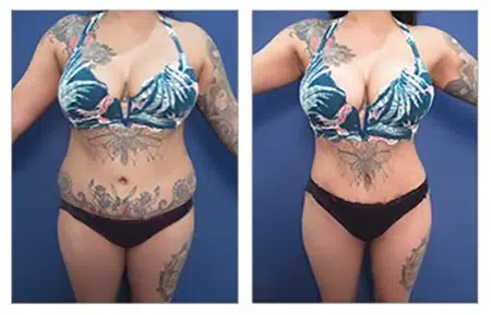 Before and after pictures of a tummy tuck with liposuction in West Hollywood.